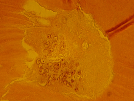 Understanding Sclerotic Bone | SteinerBio™